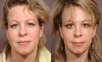 Brow Lift before 460401