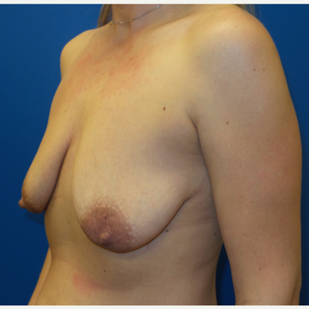25-34 year old woman treated with Breast Lift before 3253737