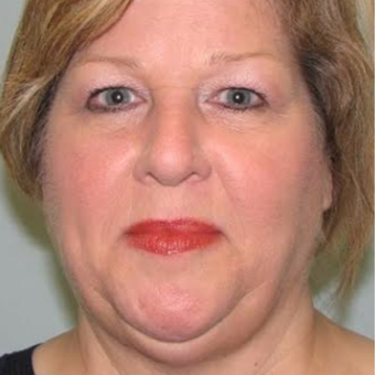 57 year old patient after 2nd Kybella Treatment before 2851420