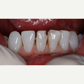 Patient treated with Dental - Composite Bonding before 3097363