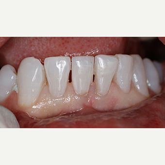 Patient treated with Dental - Composite Bonding after 3097363