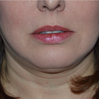 25-34 year old woman treated with Lipodissolve before 3755298