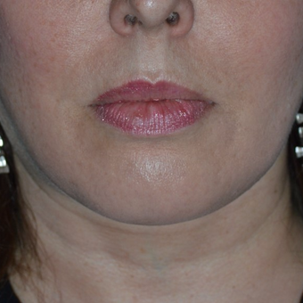 25-34 year old woman treated with Lipodissolve after 3755298
