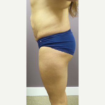 18-24 year old woman treated with Brazilian Butt Lift before 3590074
