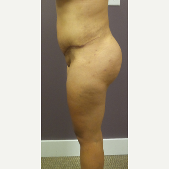 18-24 year old woman treated with Brazilian Butt Lift after 3590074