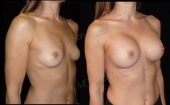25-34 year old woman treated with Breast Augmentation before 3545560