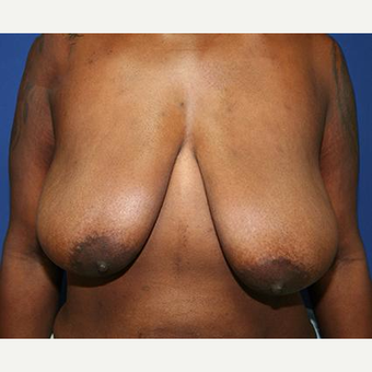 25-34 year old woman treated with Breast Lift before 3037513