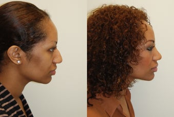African Rhinoplasty Surgery. 1 month post-op before 754370