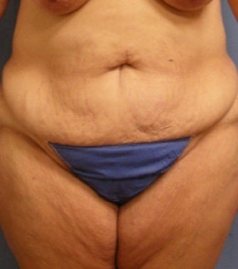 45-54 year old woman treated with Liposuction before 3589013