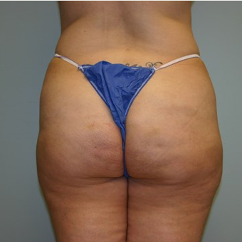 Brazilian Butt Lift before 3667588