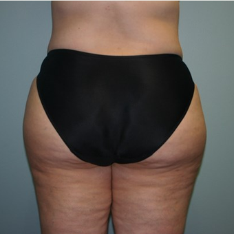Brazilian Butt Lift after 3667588