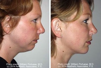 Neck Lift and Chin Implant before 91518
