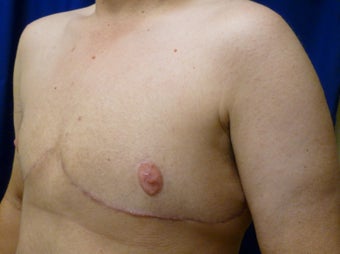 56 Year Old FTM Top Surgery 1279074