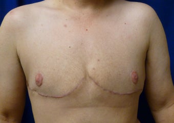 56 Year Old FTM Top Surgery after 1279074