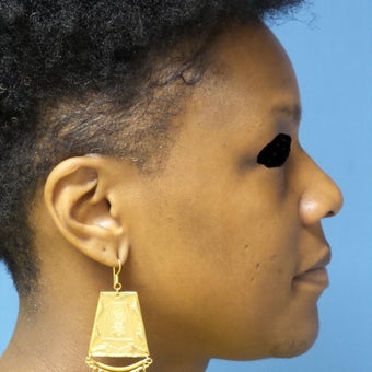 35-44 year old woman treated with African American Rhinoplasty before 2092655