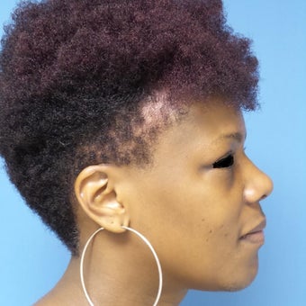 35-44 year old woman treated with African American Rhinoplasty after 2092655