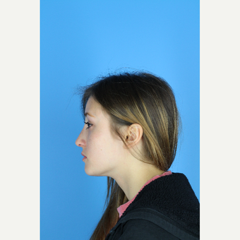 18-24 year old woman desired enhancement of her nose after 3761912