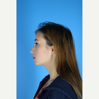 18-24 year old woman desired enhancement of her nose before 3761912