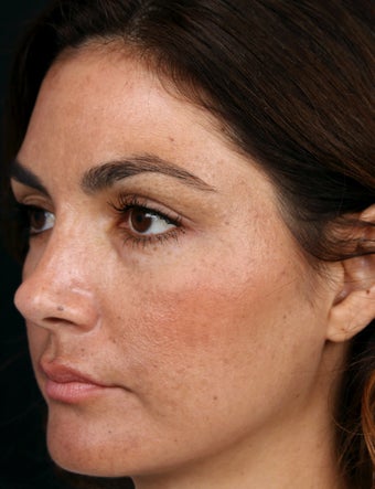 Filler for Under-Eye Hollows before 1350717