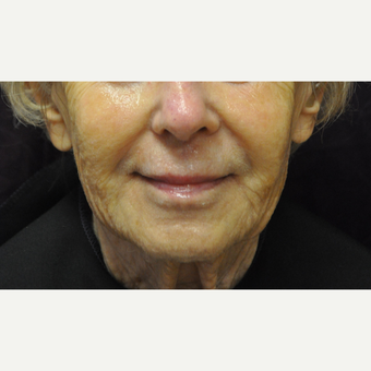 75 and up year old woman treated with Juvederm after 2881425