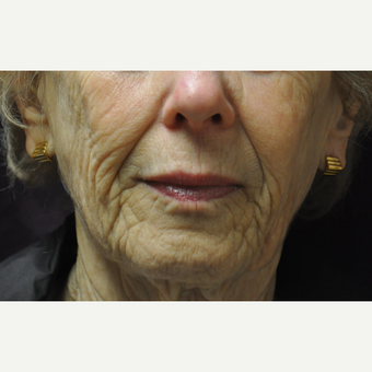 75 and up year old woman treated with Juvederm before 2881425