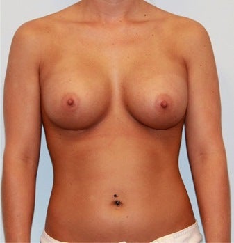 High profile 400cc silicone implants after 1017483