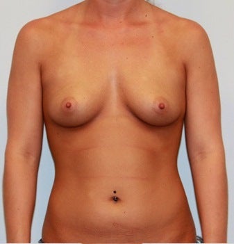 High profile 400cc silicone implants before 1017483