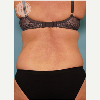 35-44 year old woman treated with Liposuction before 3016642