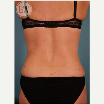 35-44 year old woman treated with Liposuction after 3016642