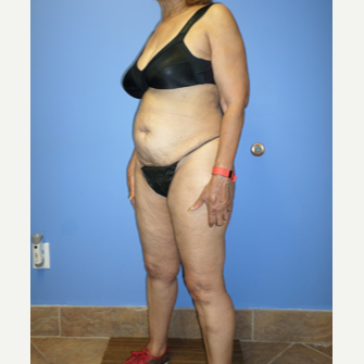 75 and up year old woman treated with Weight Loss before 3370173