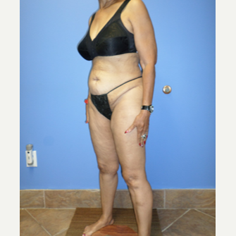 75 and up year old woman treated with Weight Loss after 3370173