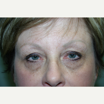 55-64 year old woman treated with Eyelid Surgery before 3339728