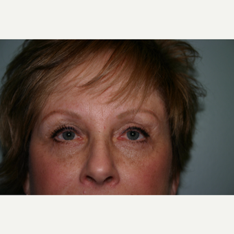 55-64 year old woman treated with Eyelid Surgery after 3339728