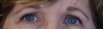 58 year old woman post Eyelid Surgery after 3743913