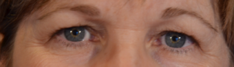 58 year old woman post Eyelid Surgery before 3743913