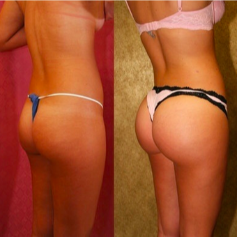 25-34 year old woman treated with Vaser Liposuction before 3873227
