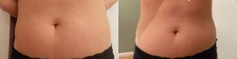 Lymph Drainage and Ultrasonic Cavitation before 1067658