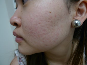 Acne and scars treated with eMatrix after 1440887