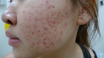 Acne and scars treated with eMatrix before 1440887