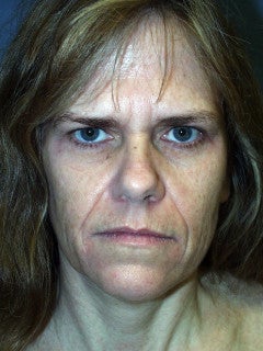 This 52-year-old Woman had a Face Lift, an Endoscopic Brow Lift, and a Lower Blepharoplasty before 1235703