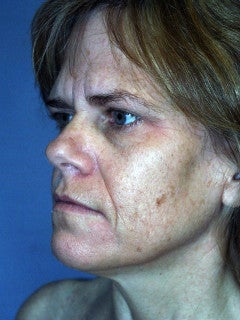 This 52-year-old Woman had a Face Lift, an Endoscopic Brow Lift, and a Lower Blepharoplasty 1235703