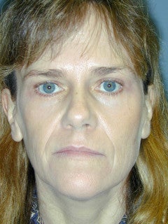 This 52-year-old Woman had a Face Lift, an Endoscopic Brow Lift, and a Lower Blepharoplasty after 1235703