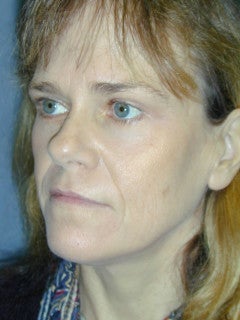 This 52-year-old Woman had a Face Lift, an Endoscopic Brow Lift, and a Lower Blepharoplasty 1235703