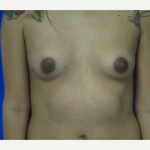 Breast Implant Revision before 3168554