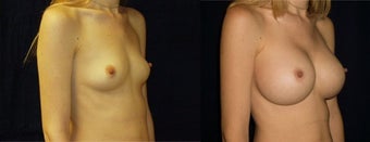 Mentor Smooth Round Moderate Profile, Saline, Size; 625cc filled to 650cc after 995440