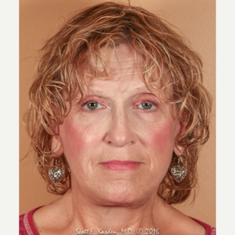 65-74 year old woman treated with SMAS Facelift after 3612141