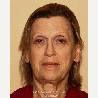65-74 year old woman treated with SMAS Facelift before 3612141