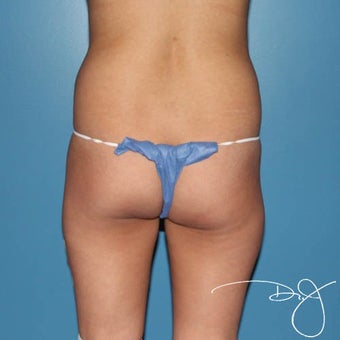 25-34 year old woman treated with Brazilian Butt Lift before 1899692
