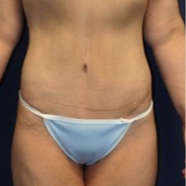 18-24 year old woman treated with Tummy Tuck after 1679390