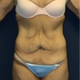18-24 year old woman treated with Tummy Tuck before 1679390